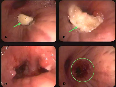 14 ngày ho không dứt, bác sĩ lấy ra thứ không ngờ từ phổi cụ ông 85 tuổi