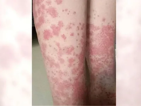 Nhuộm tóc liên tục, nữ sinh nhập viện vì thận “chảy máu”