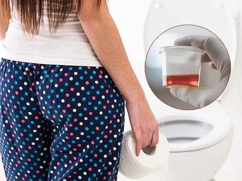 Tiểu ra máu dữ dội, người phụ nữ 42 tuổi nhập viện vì "thủ phạm thầm lặng"