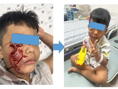 Bé trai 5 tuổi đang chơi trong sân nhà bất ngờ bị chó lao đến cắn rách mặt, phải khâu 20 mũi