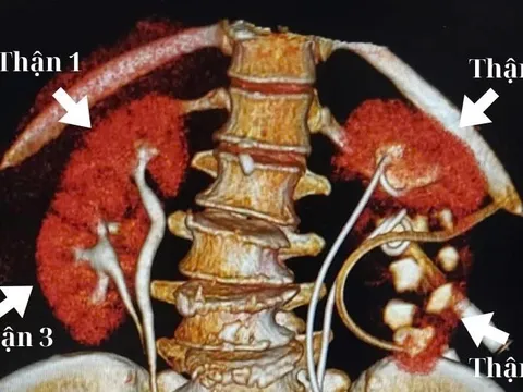 Đi khám vì đau lưng, người phụ nữ bất ngờ phát hiện mình có 4 quả thận