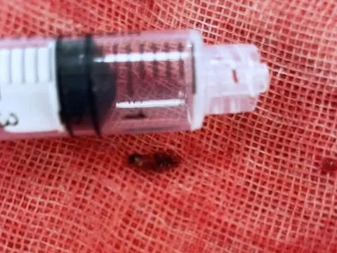 Suýt mất mạng vì vợ chích lể ngón tay chữa đột quỵ theo mạng xã hội