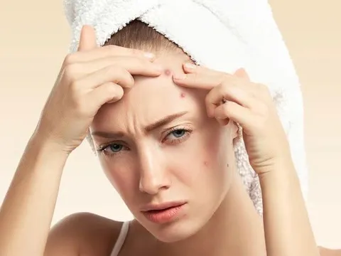 6 món ăn khiến mụn bùng phát và bí quyết ăn uống để “cứu” làn da