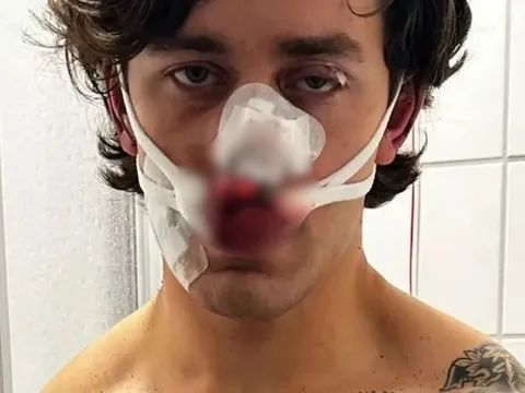 Mỹ nam 21 tuổi xông vào bảo vệ hai cô gái, khuôn mặt điển trai tan tành sau nhát dao trên tàu điện