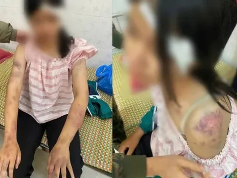 Bé gái 13 tuổi bị bà nội và hai người đàn ông đánh bầm dập: Xót xa hoàn cảnh quá éo le
