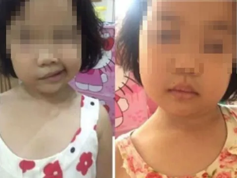 Con gái 4 tuổi méo miệng khi vừa ngủ dậy, mẹ tưởng bị đột quỵ hóa ra do sai lầm khi dùng điều hòa