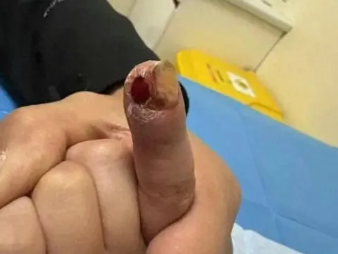 Cậu bé 7 tuổi suýt cắt bỏ ngón tay, bác sĩ nói nguyên nhân đến từ thói quen hàng ngày của trẻ, người mẹ hối hận