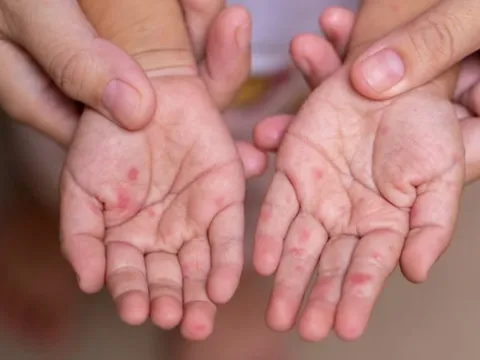 Hà Nội cảnh báo "nóng" sau ca tử vong đầu tiên do sởi