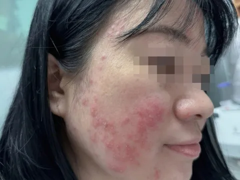 Tin vào một video viral trên Tiktok, nữ sinh tự "băm nát" gương mặt vì mải mê chữa mụn