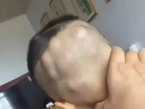 Con đi chơi về mẹ phát hiện đầu bé mọc nhiều khối u lớn như hạt óc chó, đến bệnh viện khám liền thất kinh