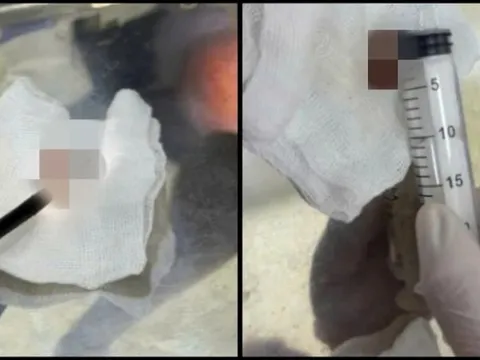 Món ăn "chua chua mặn mặn" vạn người mê này khiến cụ ông 72 tuổi nhập viện gấp