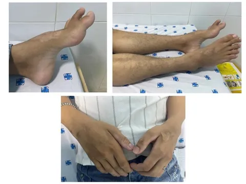 Mắc bệnh hiếm gặp từ biểu hiện tê yếu tay chân, không thể chủ quan với biểu hiện sức khỏe này