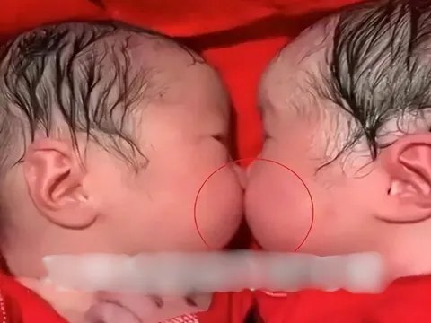 Cặp sinh đôi bám chặt lấy nhau khi mới chào đời, y tá không thể tách rời mà phải thốt lên: “Thật hiếm gặp”