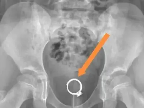 Con gái 6 tuổi kêu đau vùng dưới, bố mẹ sửng sốt khi nghe bác sĩ kết luận