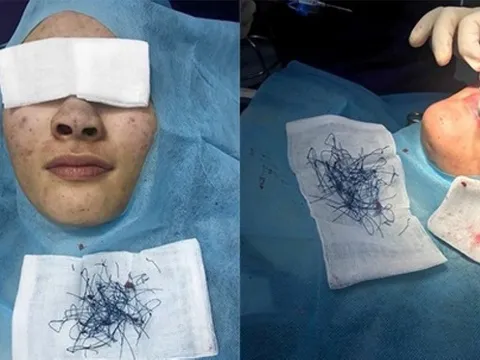 Sau ca phẫu thuật nâng mũi, cô gái bàng hoàng nhận ra thứ biến dạng trên mặt, chuyển màu xanh tím bất thường