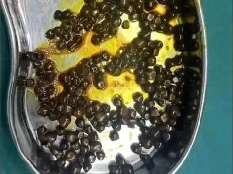 Bé gái 10 tuổi thường xuyên bỏ bữa sáng, bác sĩ phẫu thuật lấy hơn 200 viên sỏi ra khỏi dạ dày