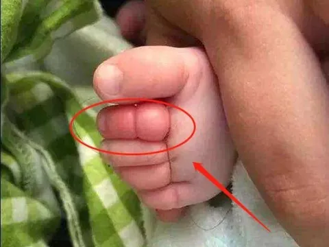 Bố đưa con 2 tuổi đi bơi, lúc về phát hiện ngón chân con phù lên đỏ tấy, đến bệnh viện bác sĩ báo tin sốc