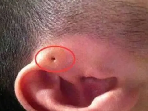 Mẹ phát hiện gần tai con xuất hiện một lỗ sâu khác thường liền tò mò bóp thử, không ngờ bác sĩ yêu cầu phẫu thuật ngay