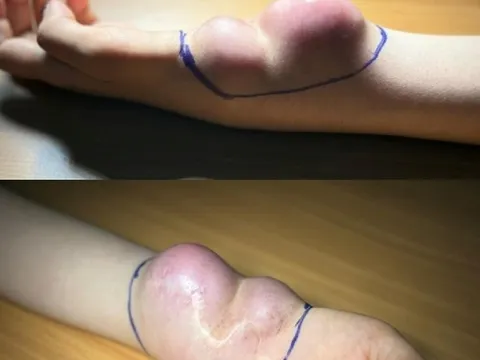 Cô gái trẻ suýt mất tay vì bệnh ung thư hiếm gặp chỉ vì chẩn đoán sai của bác sĩ