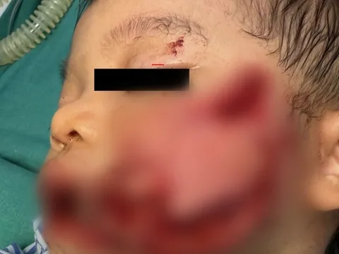 Xót xa bé 2 tuổi bị chó nhà nuôi tấn công phải nhập viện với nhiều vết thương phức tạp