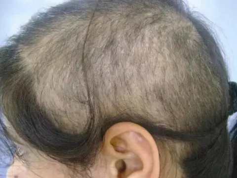 Con gái 3 tuổi rụng gần hết tóc, mẹ đưa đến bệnh viện, bác sĩ nói “Hãy báo cảnh sát”