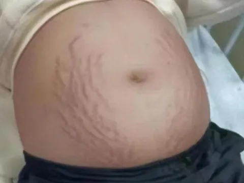 Mẹ nghi con gái lớp 3 mang thai vì bụng to bất thường, đi khám bác sĩ kết luận 5 chữ khiến mẹ gục ngã