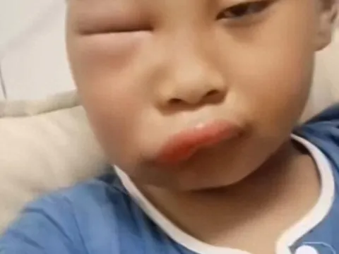 Gửi con về quê nghỉ hè với ông bà, ngày về đón mẹ tá hoả khi mặt đứa trẻ biến dạng