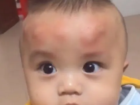 Con trai 2 tuổi ngủ dậy trên đầu liền xuất hiện nhiều khối u bất thường, người mẹ tá hoả khi biết nguyên nhân