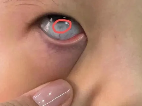 Con trai 10 tuổi mắt sưng húp, liên tục kêu ngứa, đưa đến bệnh viện khám mẹ thất kinh khi thấy vật thể lạ bên trong