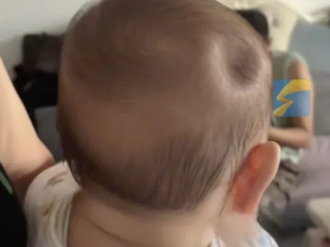 Bé trai 8 tháng tuổi gây xót xa khi đầu bị lõm xuống như một “chiếc hố”, chỉ vì sơ suất nhỏ của bố mẹ