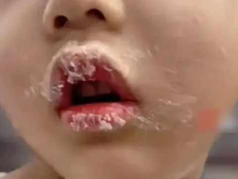 Con nếm thử keo 502 bị dính chặt môi, mẹ bình tĩnh xử lý thông minh khiến bác sĩ cũng phải khen ngợi