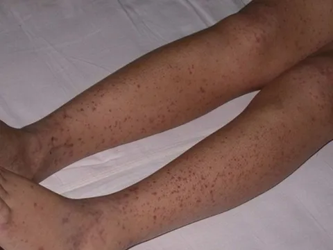 Tắm cho con gái, mẹ phát hiện chân đứa trẻ nổi loạt đốm đỏ, kết quả khám khiến gia đình đau khổ