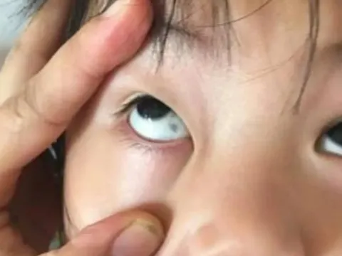 Phát hiện đốm đen trong tròng mắt con, gia đình hoang mang nhanh chóng cho bé nhập viện và cái kết không ngờ
