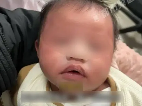 Bé sơ sinh 1 tháng tuổi nhập viện khẩn cấp vì bà nội dùng thứ nước này để pha sữa cho cháu