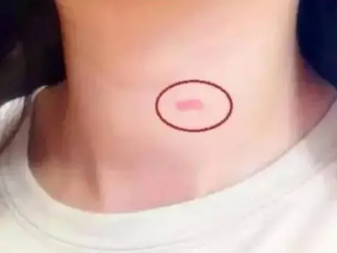 Con gái dậy thì có vết lạ trên cổ, mẹ ứng xử thông minh mọi phụ huynh nên học hỏi