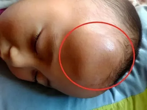 Bé 1 tuổi ngã, trên đầu hiện khối u lớn, cách xử lý của người mẹ bất ngờ nhận lời khen từ bác sĩ