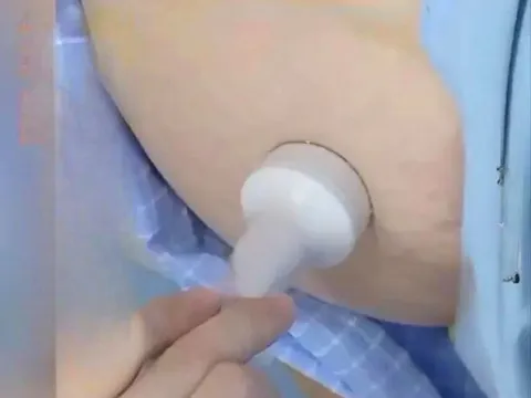 Thai nhi "mất tích" bất thường, bác sĩ lần theo dấu vết và tá hoả khi phát hiện ở vị trí không ai ngờ tới