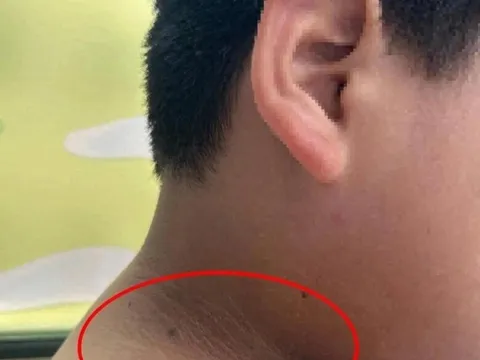 Mẹ phát hiện trên cổ, nách và đùi con trai dậy thì có những "vạch màu đen" kỳ lạ, bác sĩ cảnh báo nguy hiểm