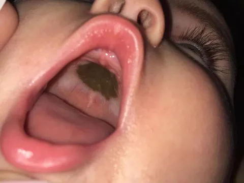 Mẹ phát hoảng thấy miệng con xuất hiện đốm đen lạ, đến bệnh viện nghe bác sĩ chúc mừng mà xấu hổ