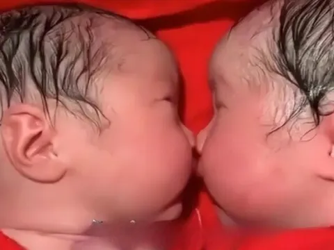 Vừa chào đời cặp chị em song sinh dính chặt nhau không rời, bác sĩ đỡ đẻ nhìn mẹ lắc đầu: “Ca này lạ quá”
