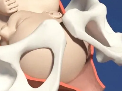 Bé gái sơ sinh chào đời với cái đầu nhọn, bố sợ hãi không nhận con, bác sĩ báo tin vui