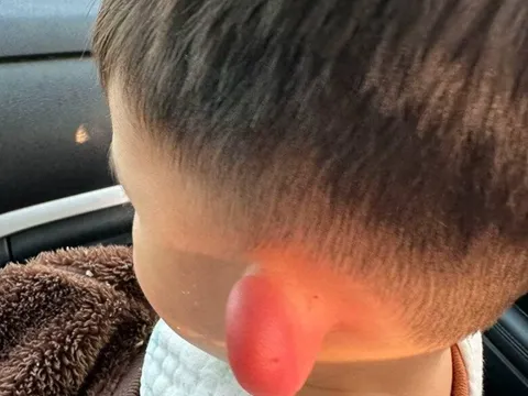 Con qua nhà hàng xóm chơi, về nhà lỗ tai bỗng sưng vù biến dạng, đưa vào viện bác sĩ khen mẹ giỏi