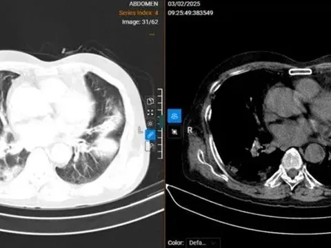 Một bệnh nhân biến chứng cúm A khiến phổi trắng xóa