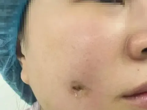 Cám cảnh: Ham má lúm đồng tiền nhân tạo, cô gái bị áp xe miệng