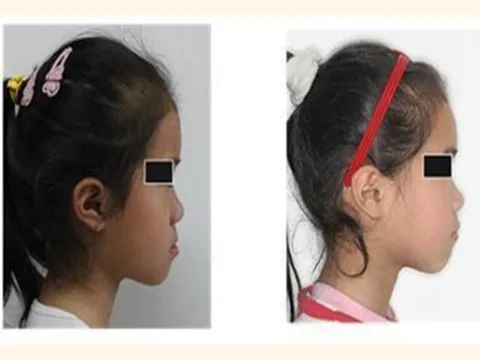 Con gái lúc nhỏ đẹp nhưng càng lớn càng móm, đến bệnh viện bác sĩ nói nguyên nhân khiến gia đình suy sụp