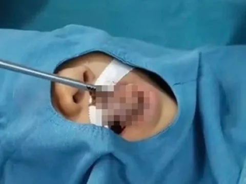 Hy Hữu: Bé trai 4 tuổi bị cá rô sống chui tọt vào cổ họng chỉ vì tò mò làm việc này, nhiều trẻ cũng như vậy