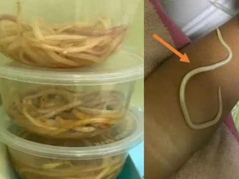 Nôn ra giun, bé 3 tuổi được bác sĩ gắp hàng chục con giun sống ra khỏi bụng: Thói quen sai lầm nhiều phụ huynh chủ quan