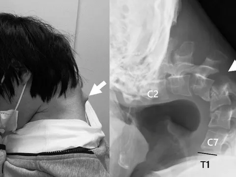 Thanh niên 25 tuổi cúi đầu xem điện thoại đột ngột đau cổ dữ dội, không thể ngẩng đầu, suýt liệt cổ: Cảnh báo giới trẻ