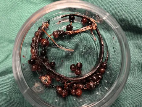 Hãi hùng: Đeo vòng tay suốt 10 năm không tháo, người phụ nữ suýt mất mạng vì vòng 'ăn' sâu vào da thịt