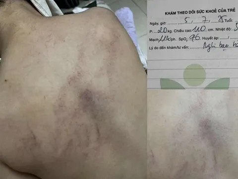Thông tin mới nhất vụ bé gái 4 tuổi đi học bị bạo hành đến tím lưng vì không chịu ngủ